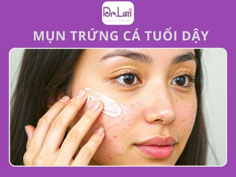 Dấu hiệu nhận biết mụn trứng cá tuổi dậy thì